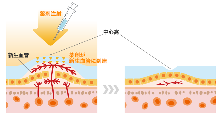 VEGF阻害薬（眼内への注射）